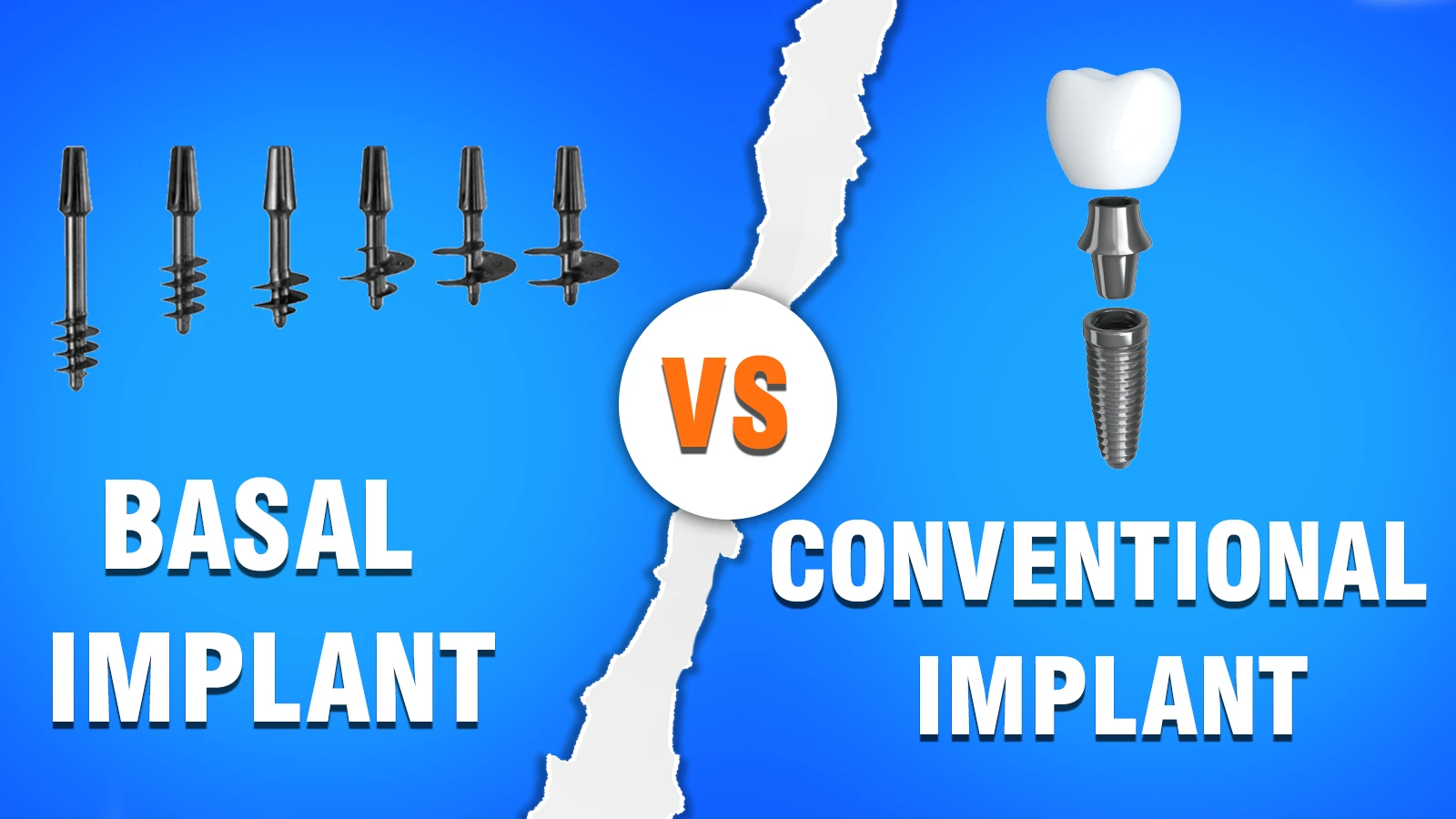 basal implant procedure in India